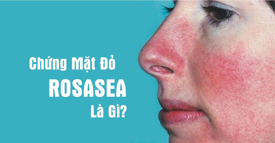 Chứng đỏ mặt - Hình ảnh minh họa